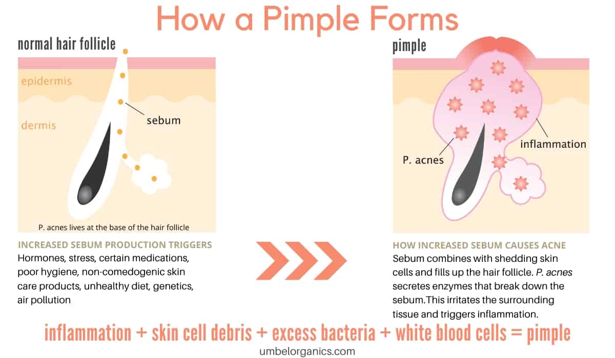 diagram of how a pimple forms